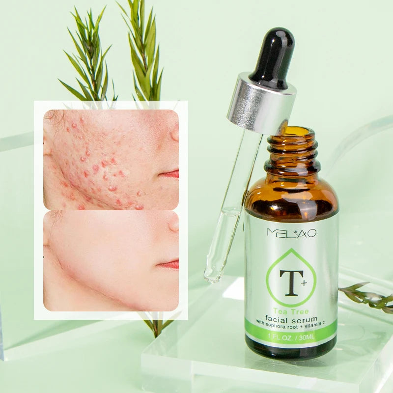 Melao Tea Tree Super Serum: Targets acne, scars, redness, and dark spots. Ideal for sensitive skin. - Theresia Cosmetics - skin care - Theresia Cosmetics