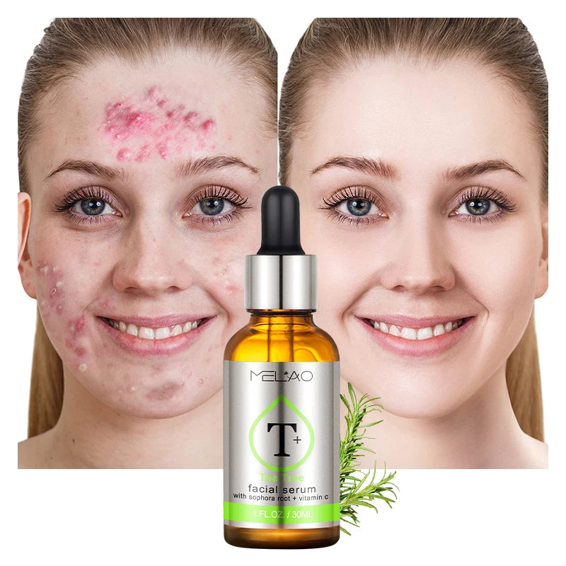 Melao Tea Tree Super Serum: Targets acne, scars, redness, and dark spots. Ideal for sensitive skin. - Theresia Cosmetics - skin care - Theresia Cosmetics