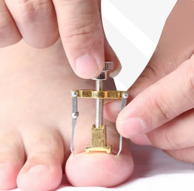 Ingrown Toenails Corrector Stainless Steel Nail Straightening Tool Relief Pain Pedicure Tool For Ingrown Toenail Recover - Theresia Cosmetics - foot care - Theresia Cosmetics