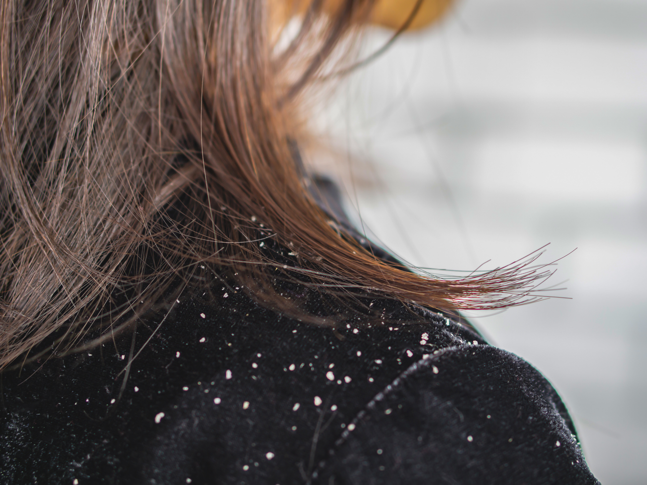 Dandruff & Scalp