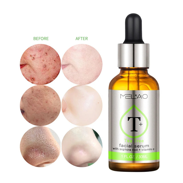 Melao Tea Tree Super Serum: Targets acne, scars, redness, and dark spots. Ideal for sensitive skin. - Theresia Cosmetics - skin care - Theresia Cosmetics