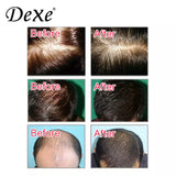 Dexe Anti-Hair Loss 30ml*6pcs - Theresia Cosmetics - hair treatment - Theresia Cosmetics